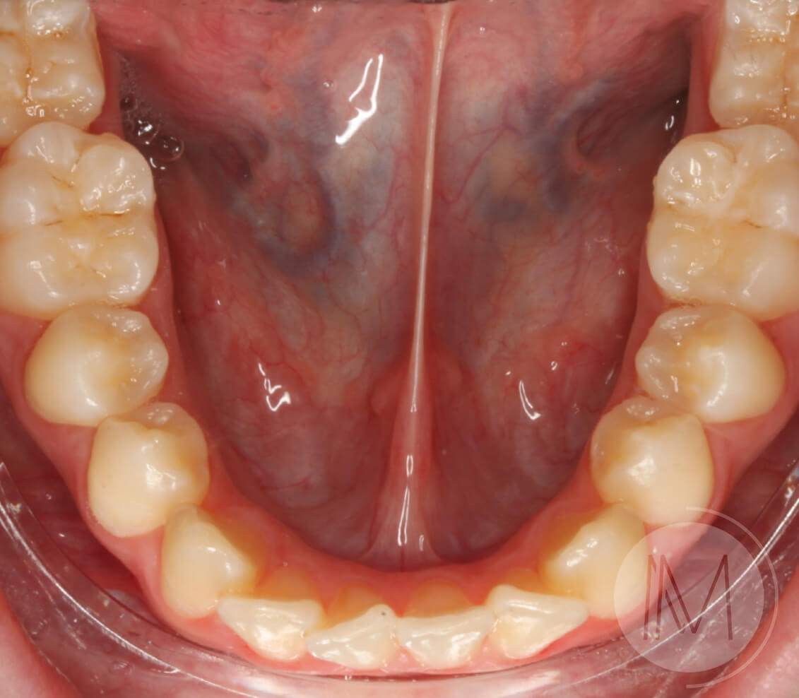 Ortodoncia infantil y Ortodoncia en adolescente 8_24