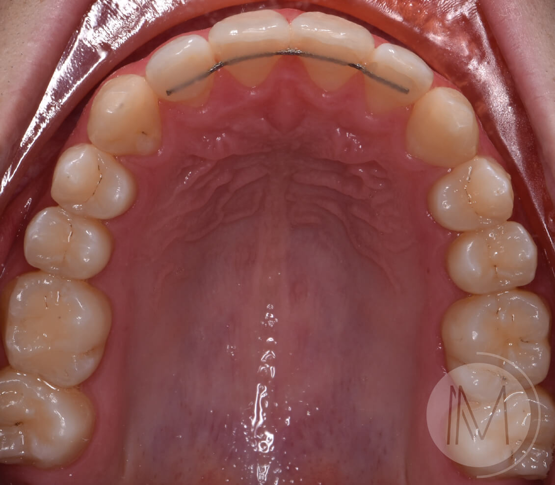 Ortodoncia infantil y Ortodoncia en adolescente 8_25