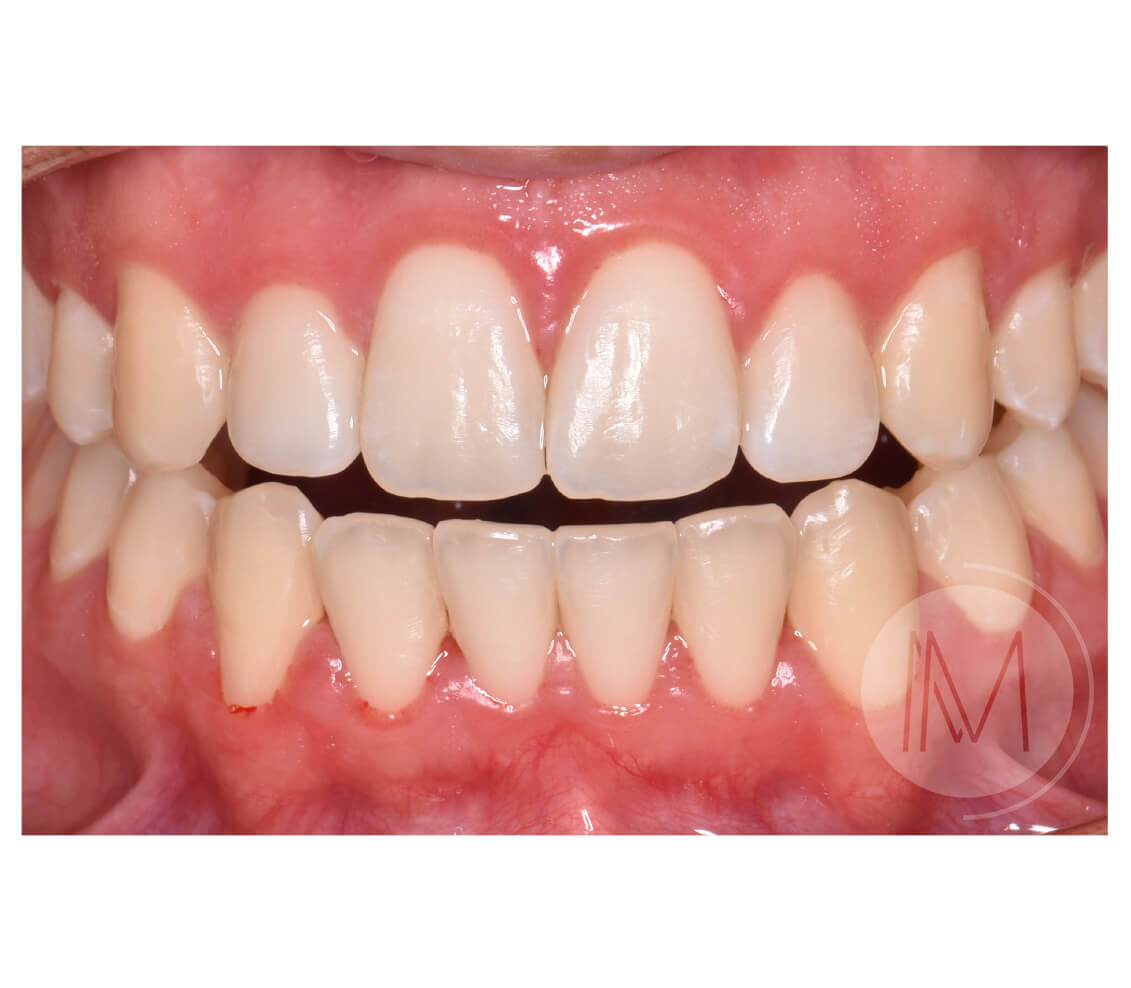Ortodoncia infantil y Ortodoncia en adolescente 8_26