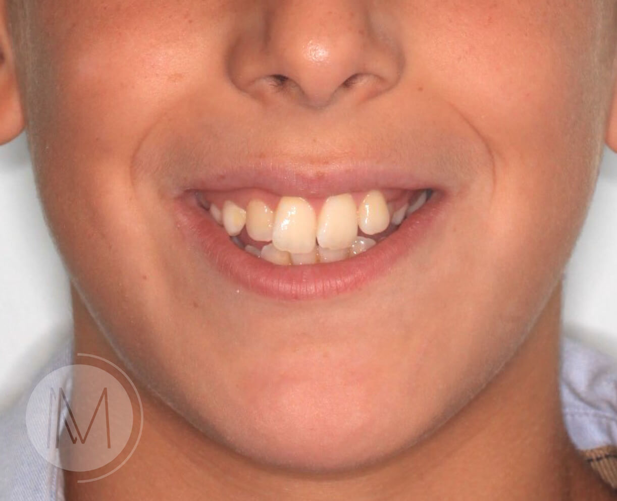 Ortodoncia infantil y Ortodoncia en adolescente 8_4