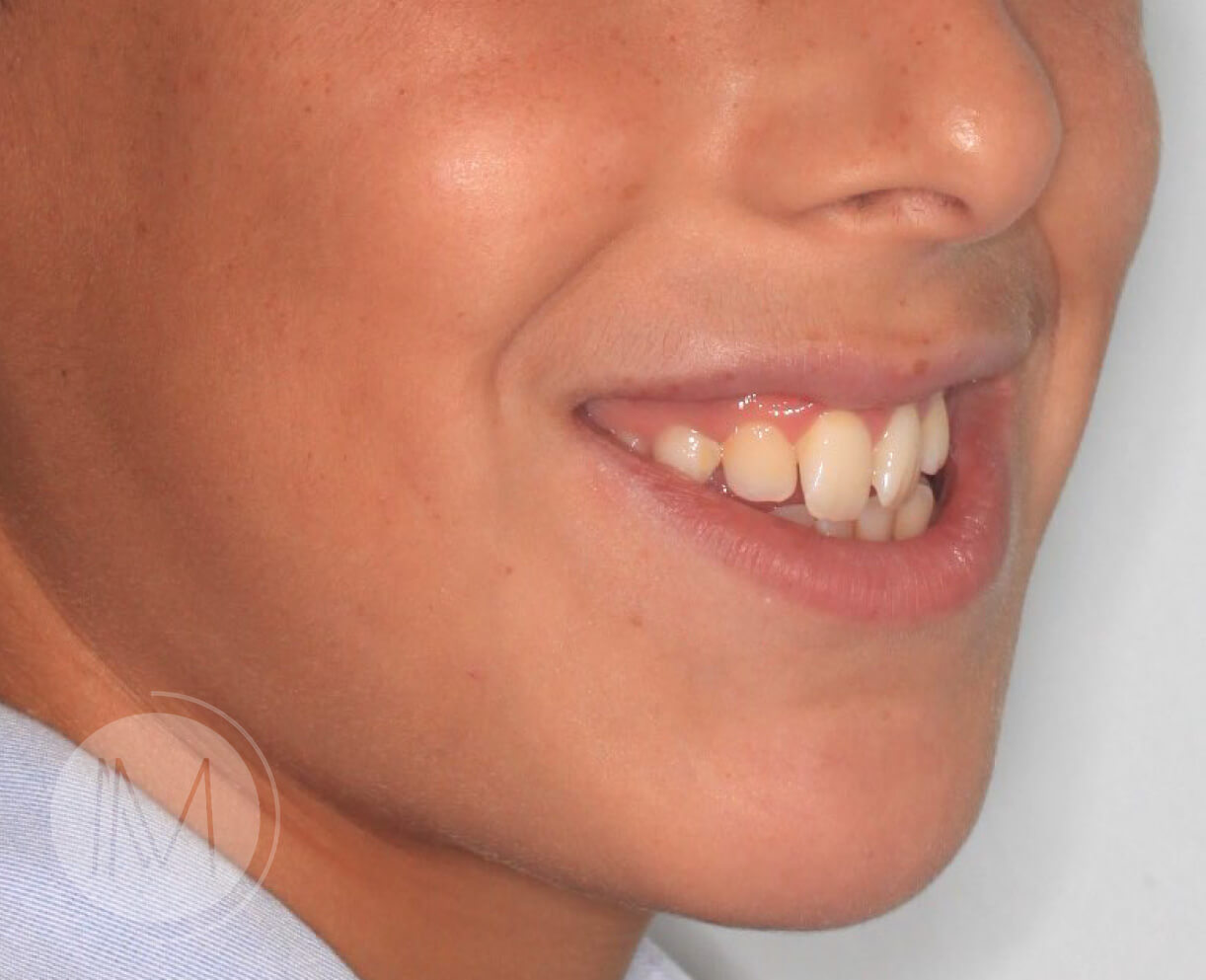Ortodoncia infantil y Ortodoncia en adolescente 8_6