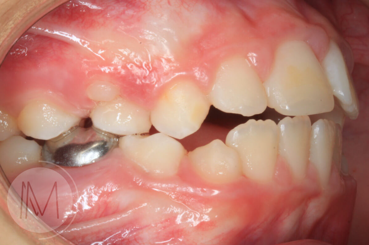 Ortodoncia infantil en mordida abierta por hábito incorrecto al tragar 9_10