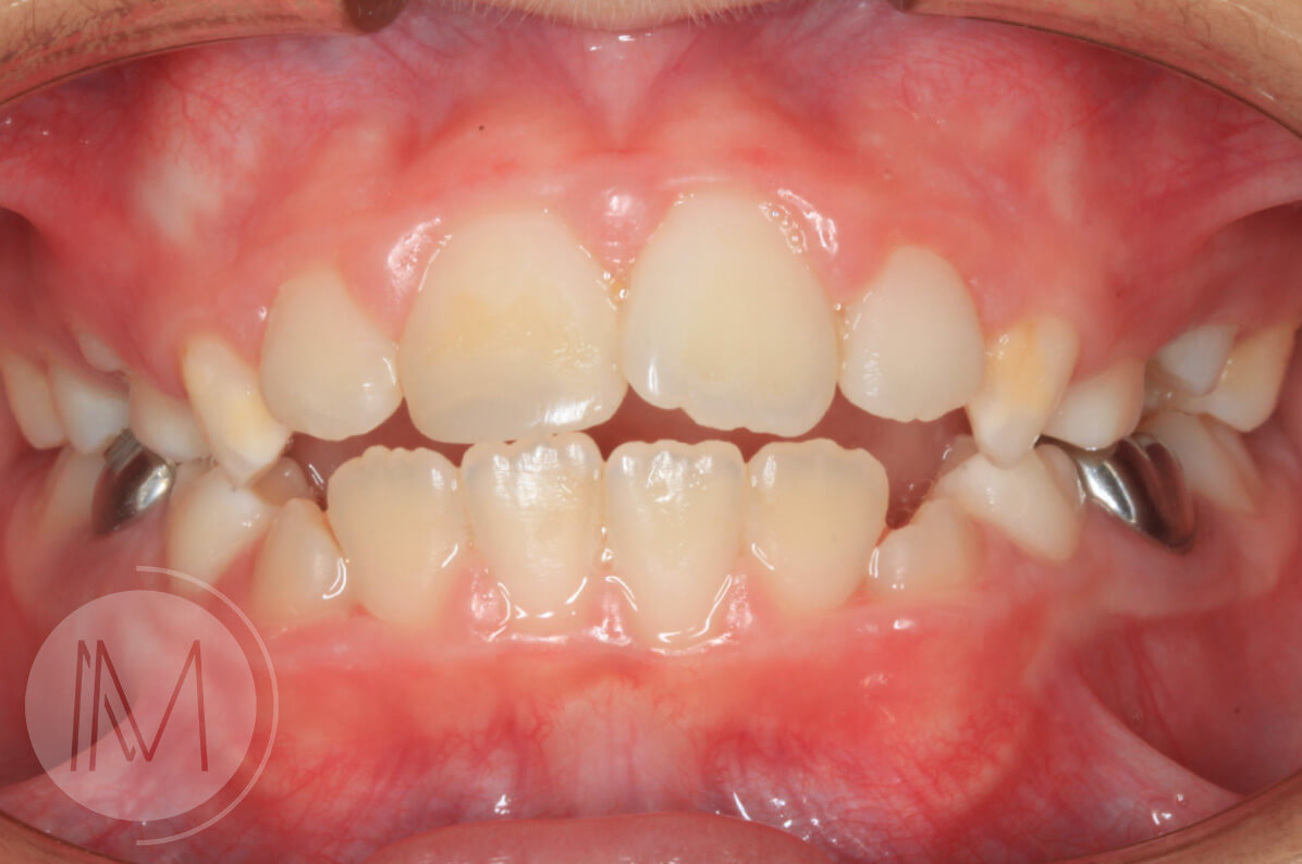 Ortodoncia infantil en mordida abierta por hábito incorrecto al tragar 9_11