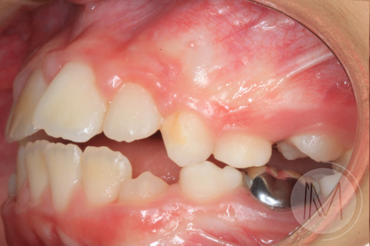Ortodoncia infantil en mordida abierta por hábito incorrecto al tragar 9_12