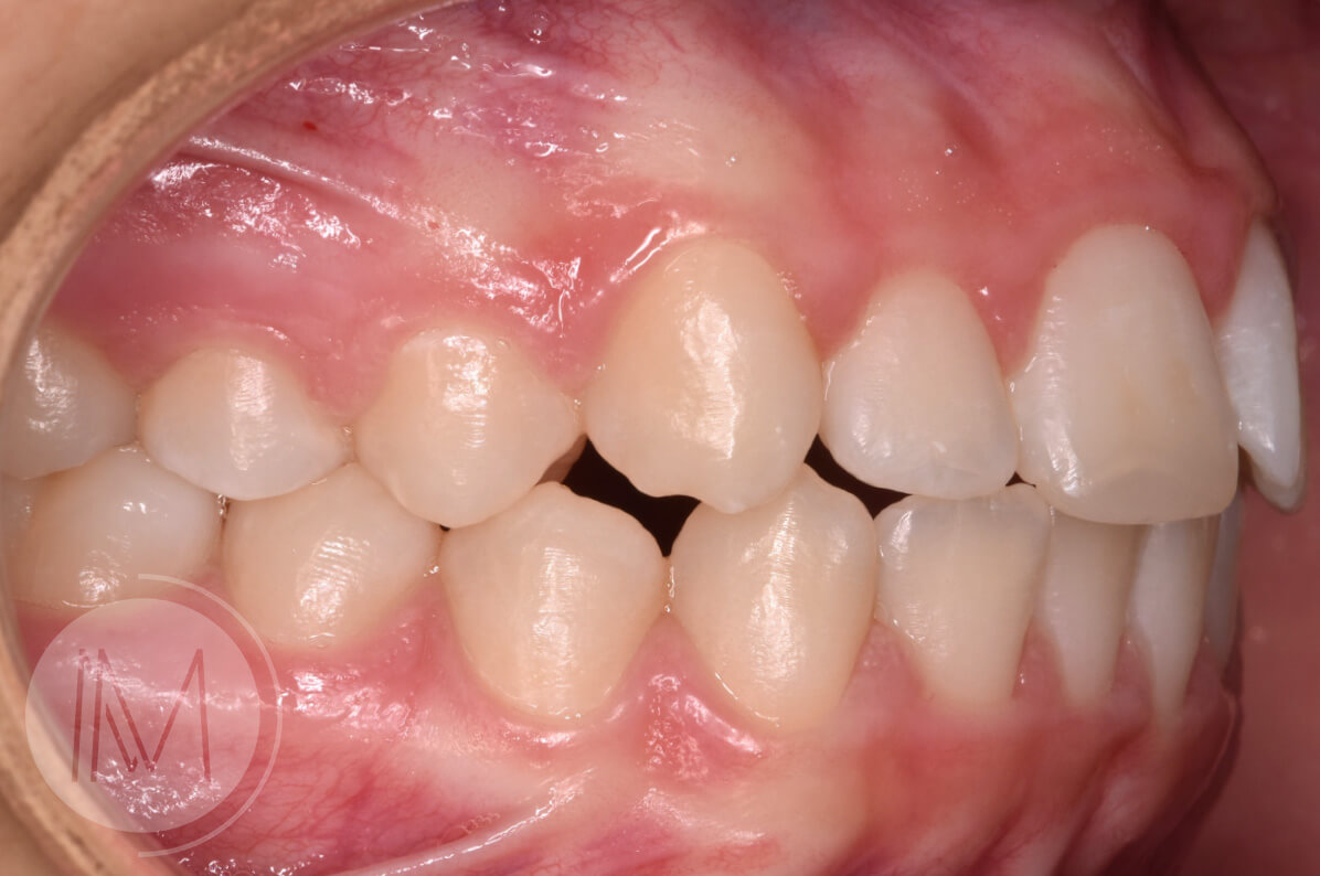 Ortodoncia infantil en mordida abierta por hábito incorrecto al tragar 9_13