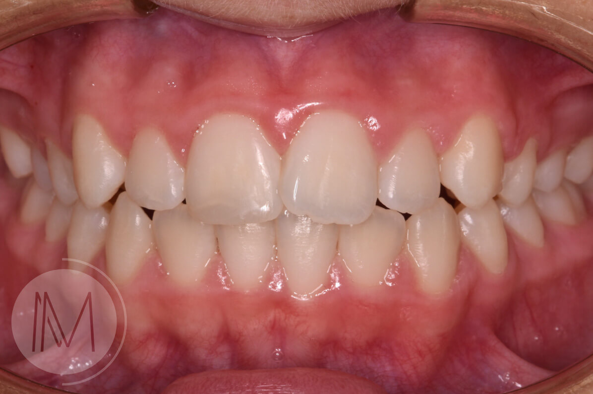 Ortodoncia infantil en mordida abierta por hábito incorrecto al tragar 9_14