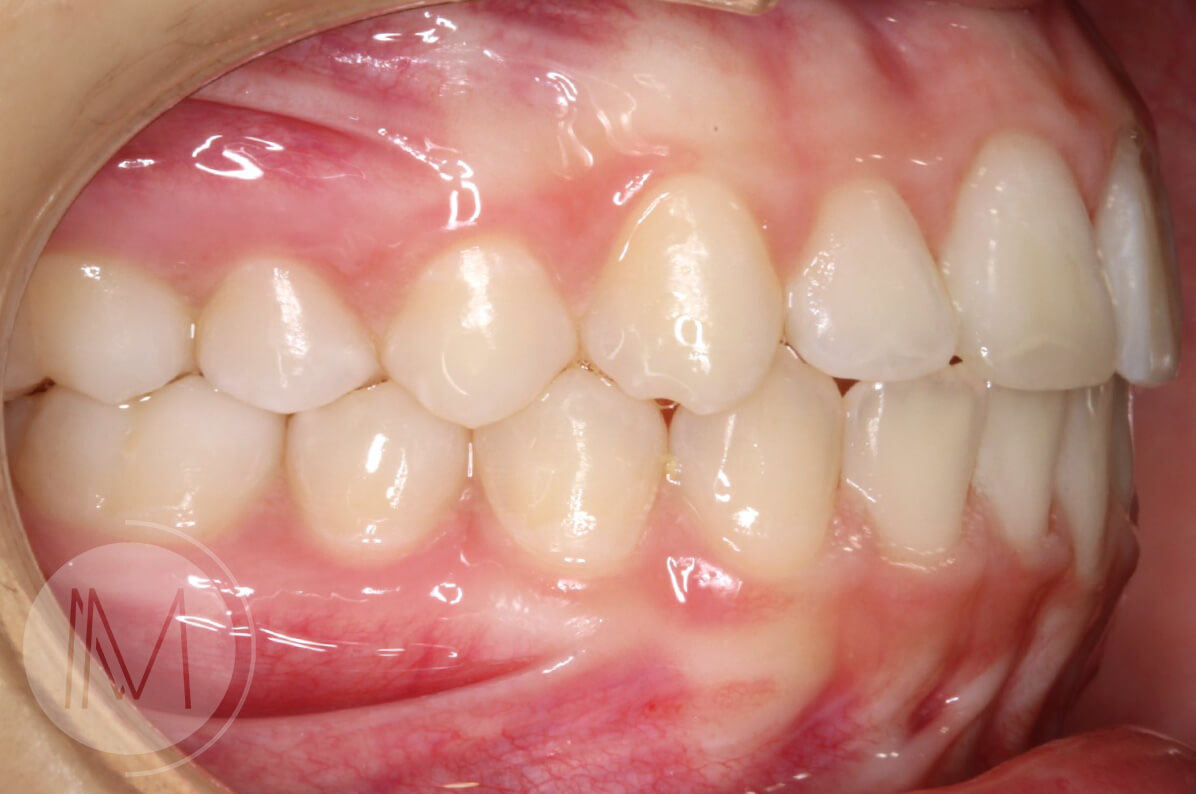 Ortodoncia infantil en mordida abierta por hábito incorrecto al tragar 9_16