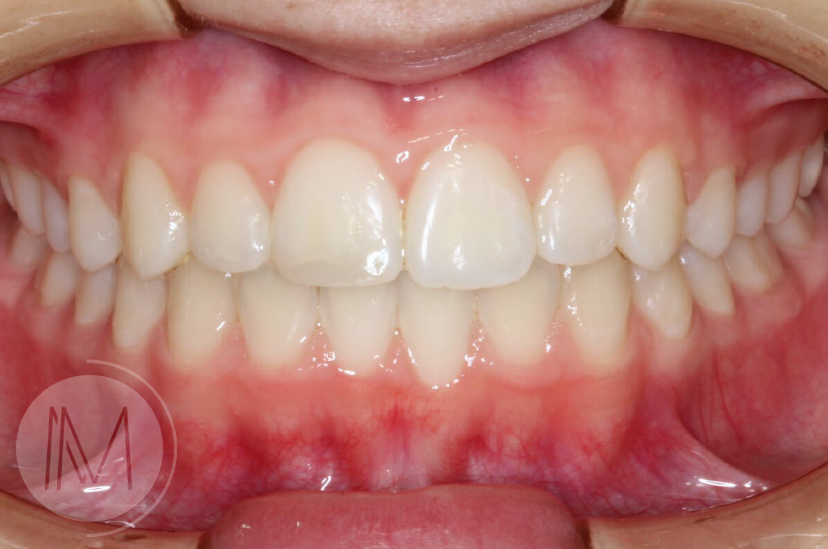 Ortodoncia infantil en mordida abierta por hábito incorrecto al tragar 9_17