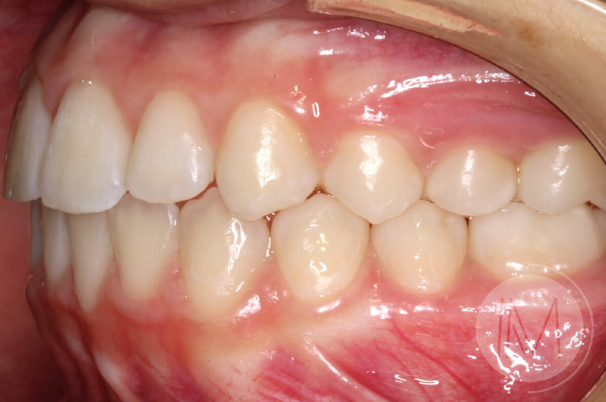 Ortodoncia infantil en mordida abierta por hábito incorrecto al tragar 9_18