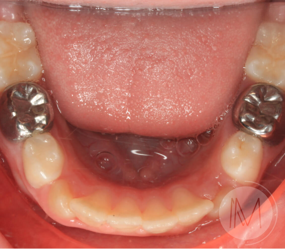 Ortodoncia infantil en mordida abierta por hábito incorrecto al tragar 9_21