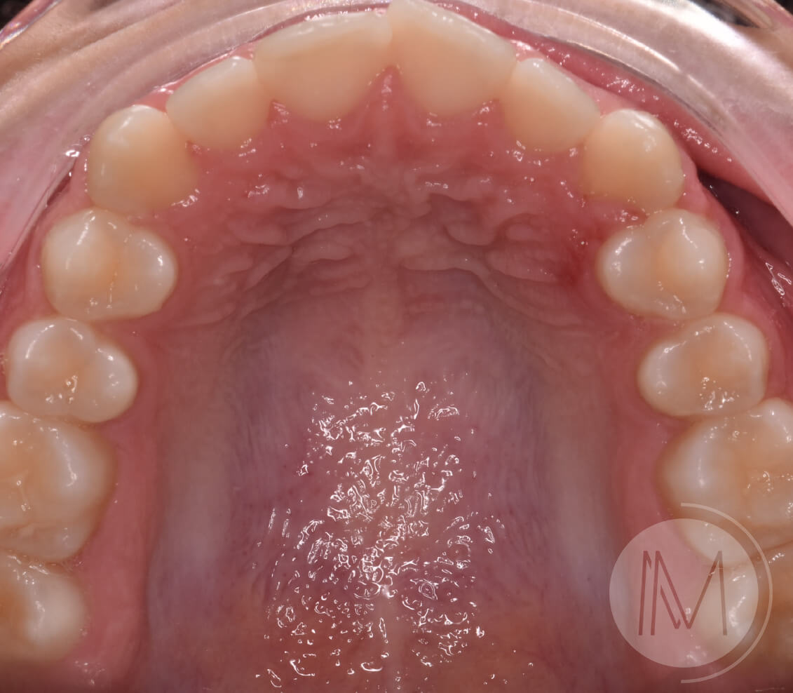 Ortodoncia infantil en mordida abierta por hábito incorrecto al tragar 9_22