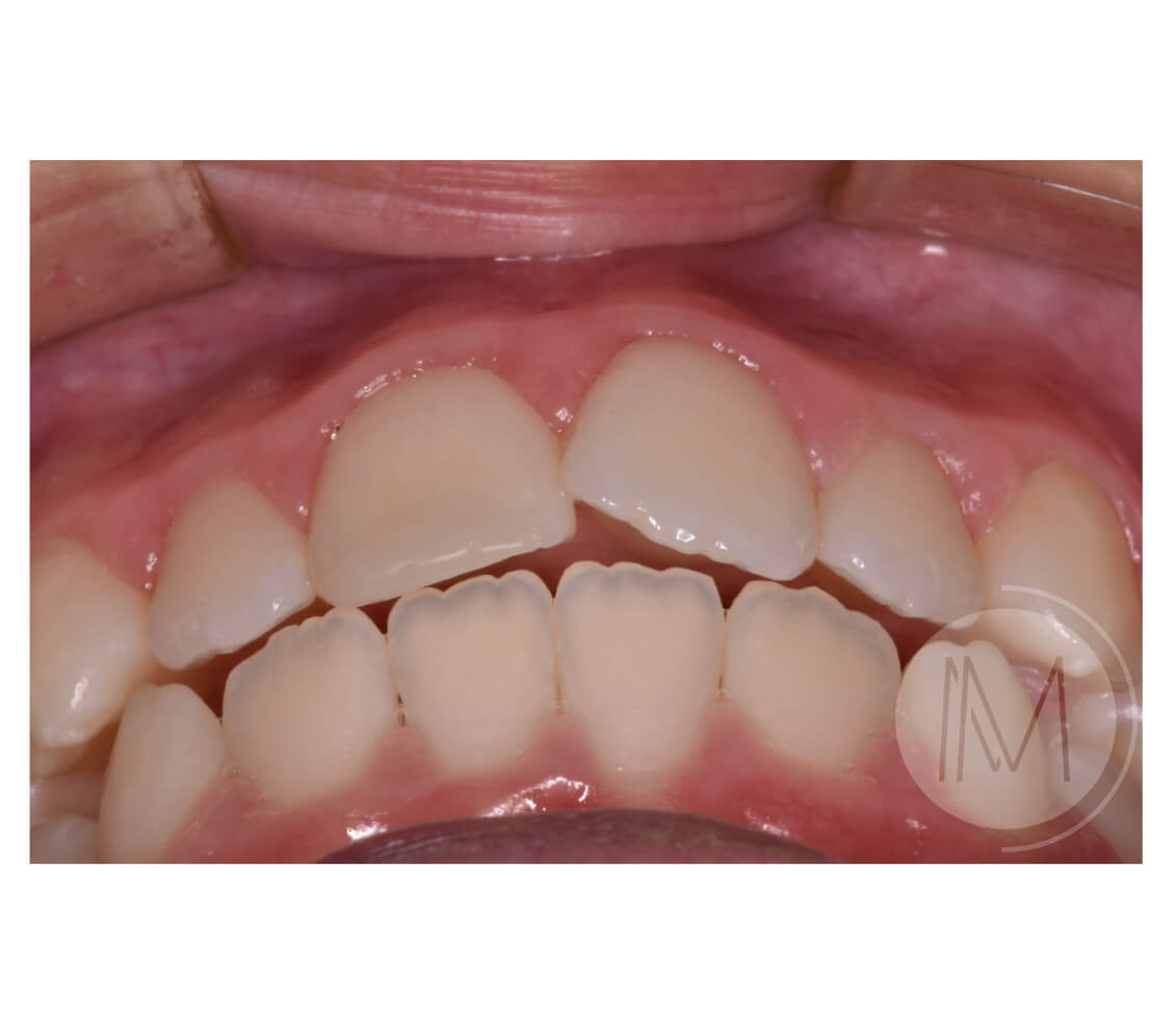 Ortodoncia infantil en mordida abierta por hábito incorrecto al tragar 9_23