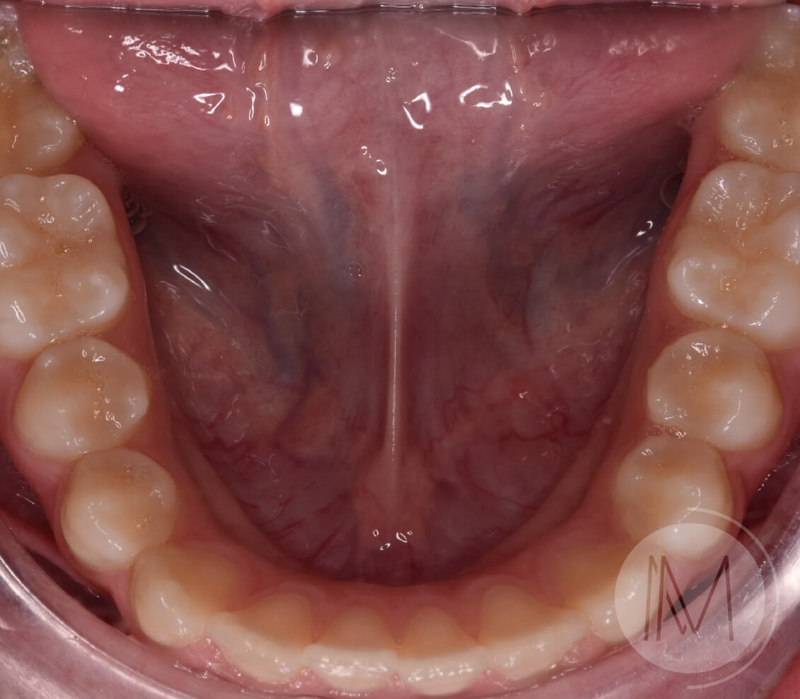 Ortodoncia infantil en mordida abierta por hábito incorrecto al tragar 9_24