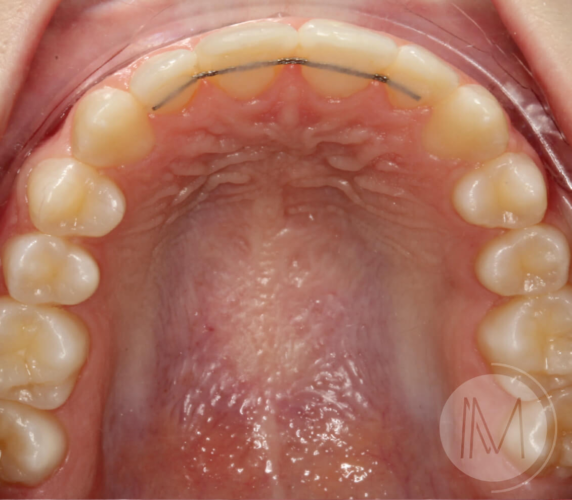 Ortodoncia infantil en mordida abierta por hábito incorrecto al tragar 9_25