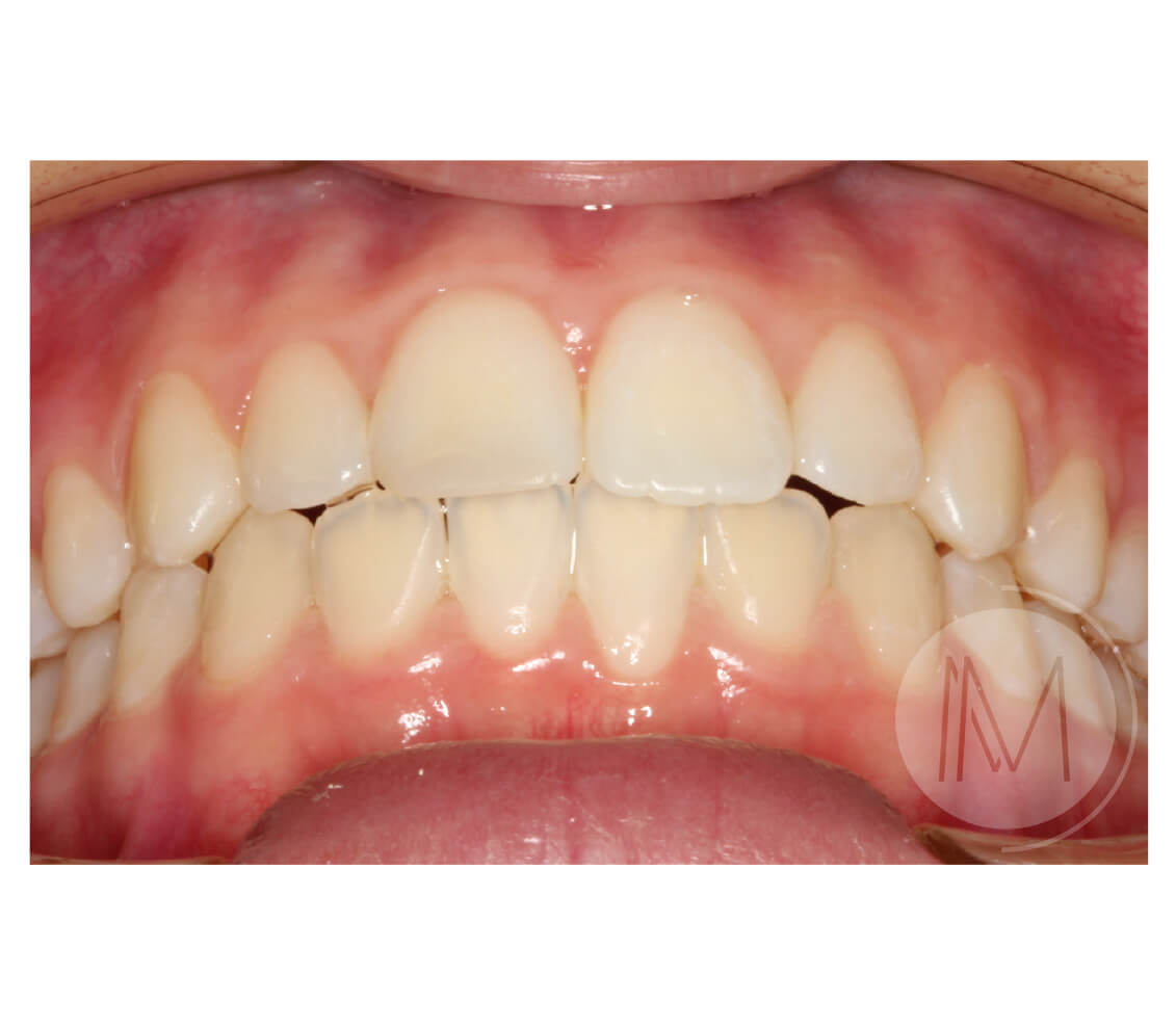 Ortodoncia infantil en mordida abierta por hábito incorrecto al tragar 9_26