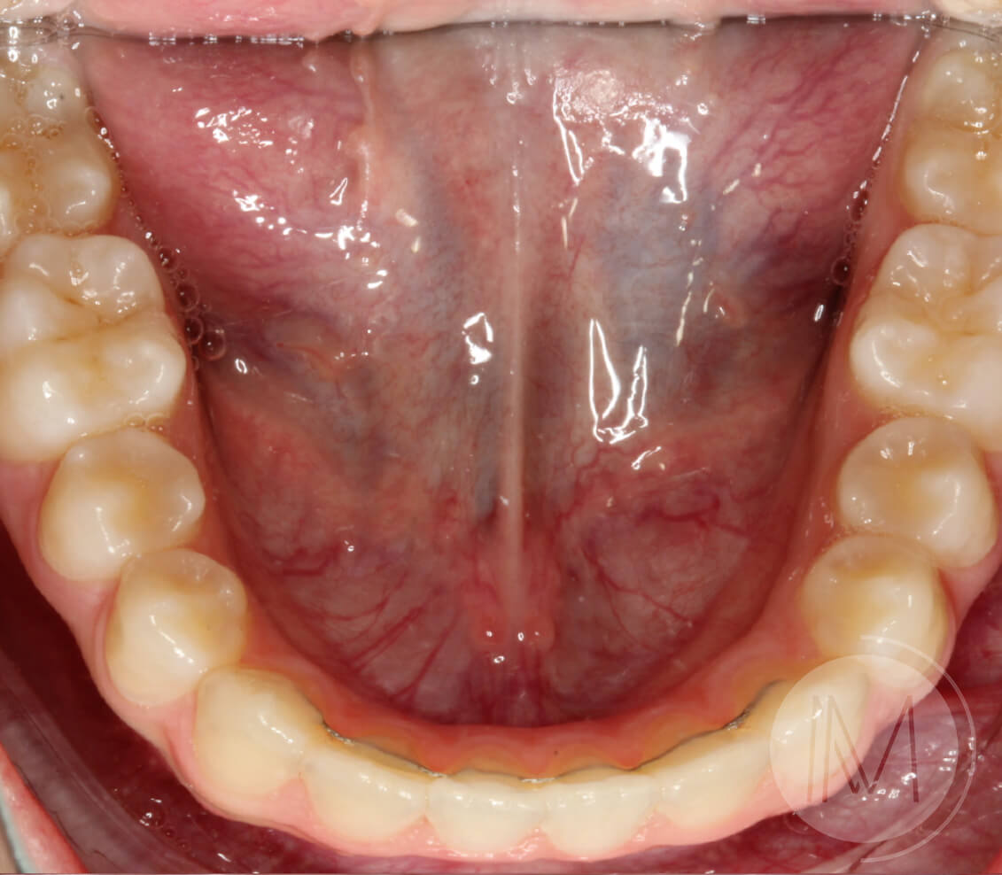 Ortodoncia infantil en mordida abierta por hábito incorrecto al tragar 9_27