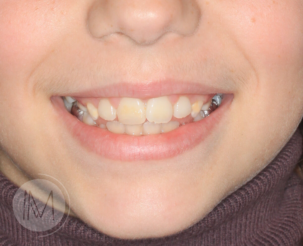 Ortodoncia infantil en mordida abierta por hábito incorrecto al tragar 9_4