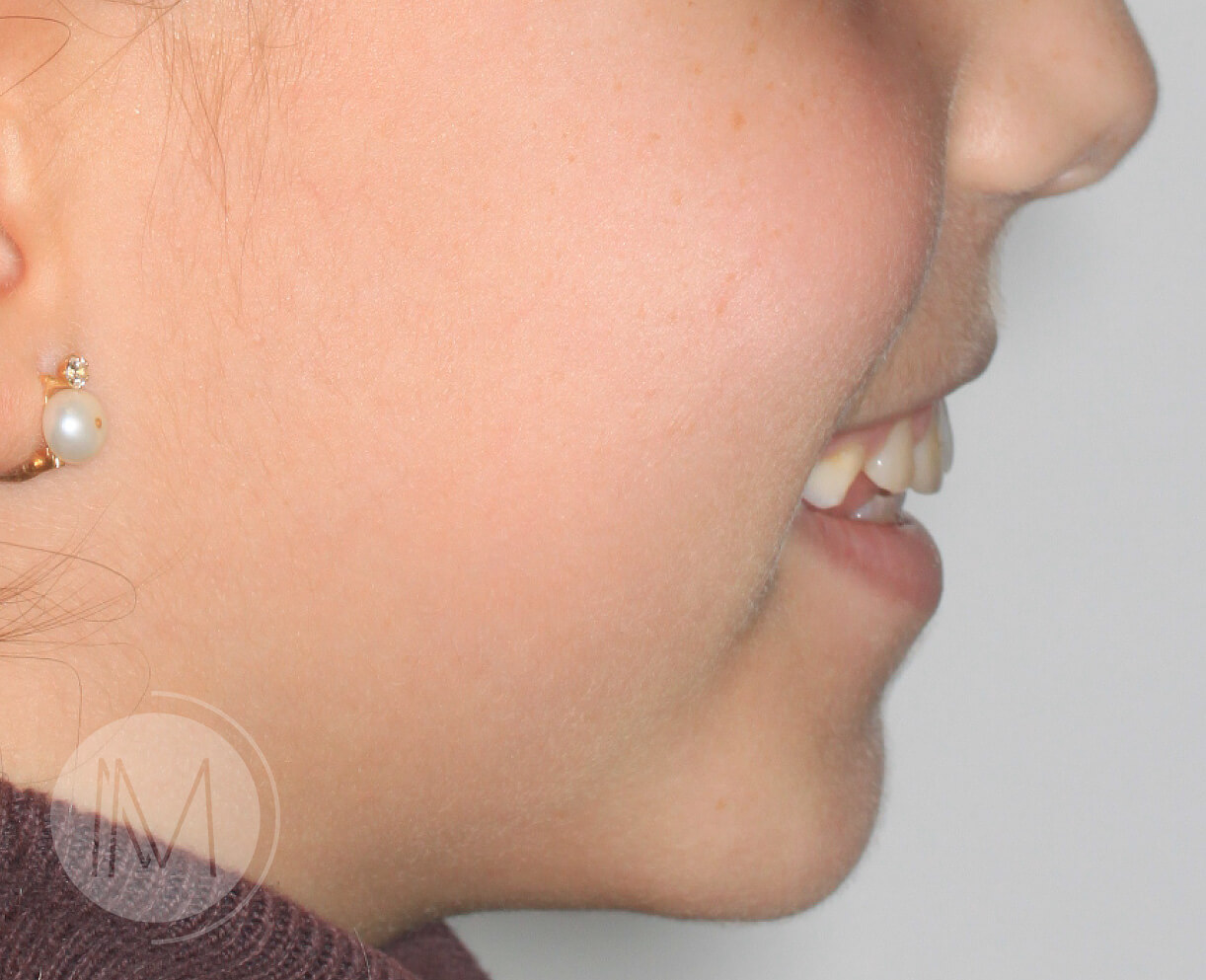 Ortodoncia infantil en mordida abierta por hábito incorrecto al tragar 9_5