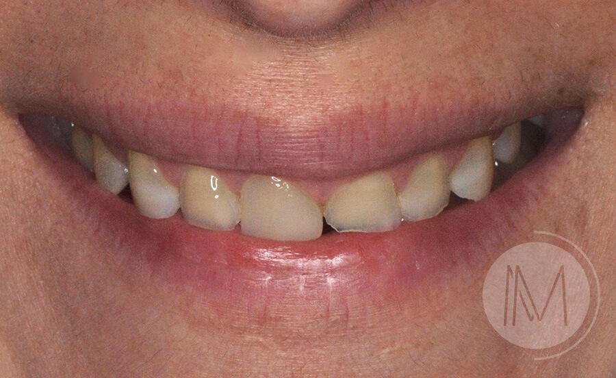 coronas-dentales-1