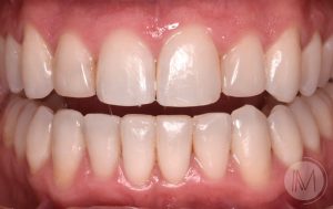 caso2 despues mejor blanqueamiento dental
